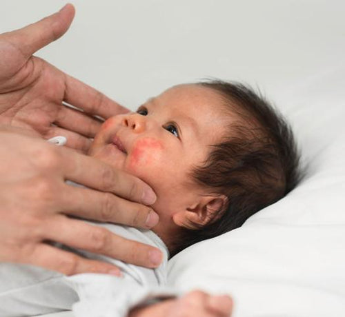 Bébé avec les joues rouges à cause de l'eczéma atopique - Mustela Belgium - 1