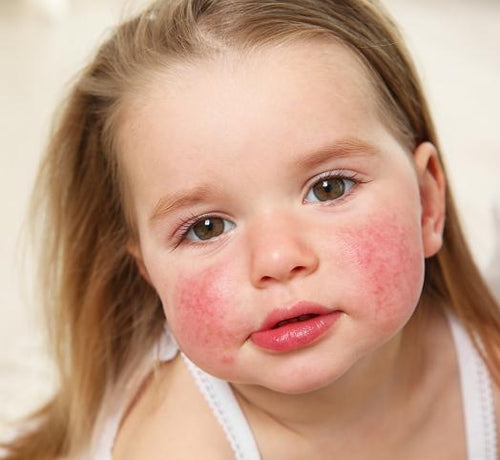 Enfant fille blonde avec les joues rouges ayant de l' eczéma atopique - Mustela Belgium - 1