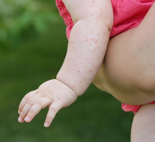 Gros plan sur un bras d'enfant qui a des points rouges sur la peau - Mustela Belgium - 1