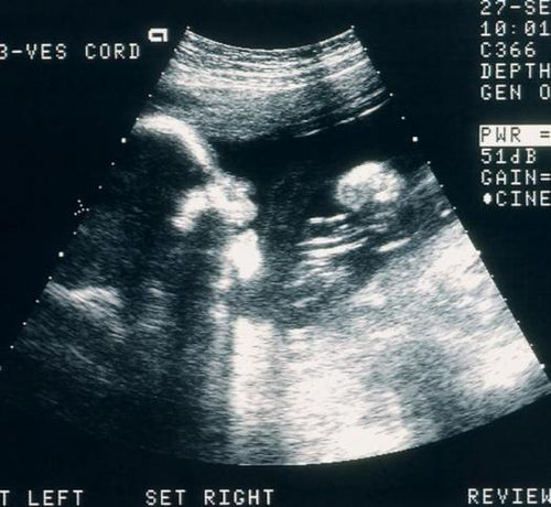 Photo d'une échographie d'un bébé - Mustela Belgium - 1