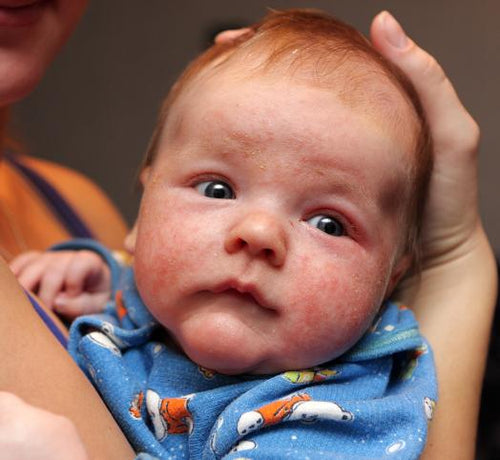 Qu'est ce que l'eczéma atopique? - Mustela Belgium - 1
