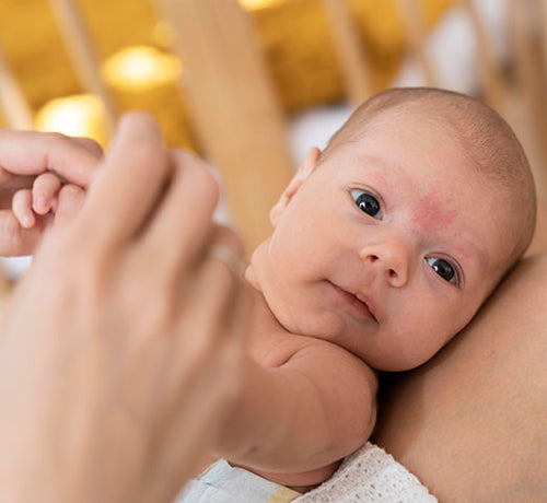 Eczéma ou psoriasis : comment faire la différence ? - Mustela Belgium - 1