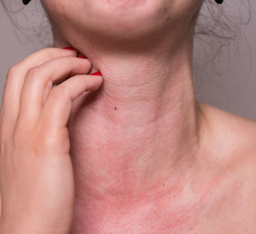 Allergies au soleil : comprendre et traiter les réactions au soleil - Mustela Belgium - 1